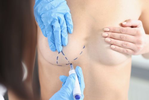 Image of marking the correct position for breast reduction procedure